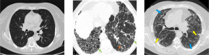 Interstitial Lung Disease: Management principles for Primary Care