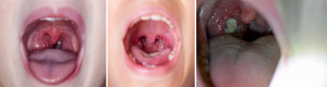 Sore throats; NOT all are infective!